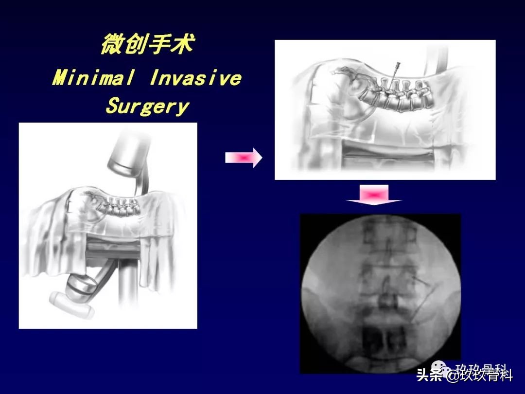 腰椎不稳最坏的结果,腰椎不稳的最佳治疗方法