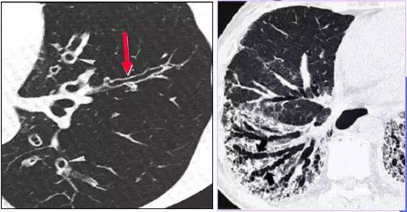 肺部ct十大征象,肺部ct正常图和异常图的区别