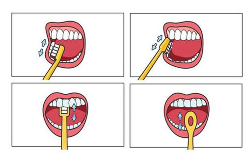 牙龈萎缩造成塞牙最好的解决办法,牙龈萎缩前牙黑三角严重如何修复