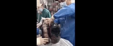 打开死者的肺,才明白有3亿人,在悄悄花钱买死