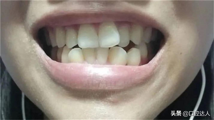 牙齿矫正可以只做单排吗,单排牙齿矫正一般要多少钱