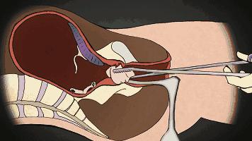 25岁的女生有几次打胎,女子堕胎6次连医生都惊讶了