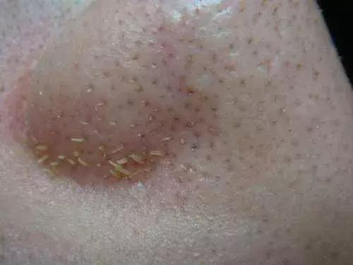 人人都会长黑头吗,好多人都长黑头吗