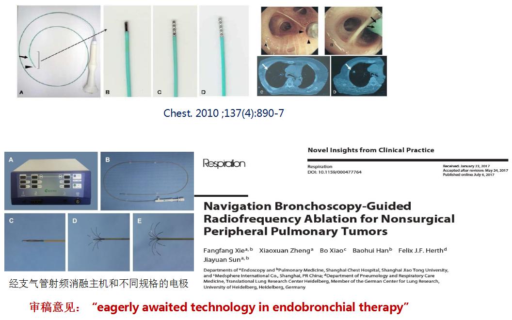 小细胞肺癌的气管镜介入治疗,导航支气管镜在肺癌诊断中的应用