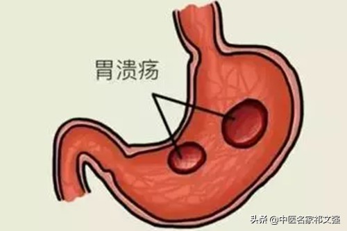 中医治愈胃十二指肠溃疡,胡希恕治胃溃疡医案