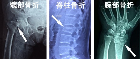 老人家摔了进icu的存活率,摔倒了住进icu了
