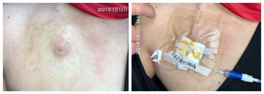 输液港皮肤过敏的处理,输液港输液有肿胀怎么处理