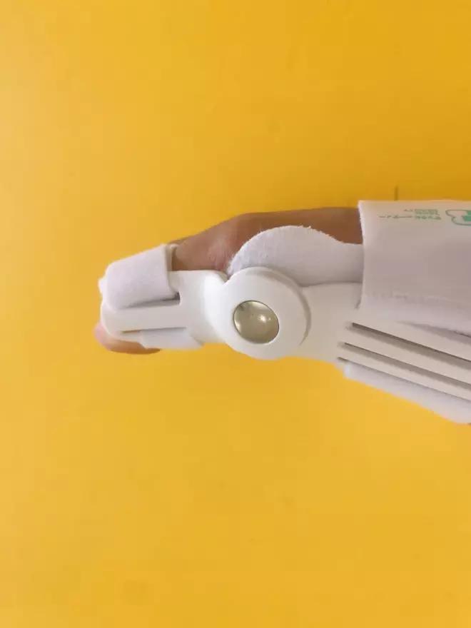 大脚趾拇指外翻矫正用多久,大脚拇指外翻导致第二脚趾弯曲