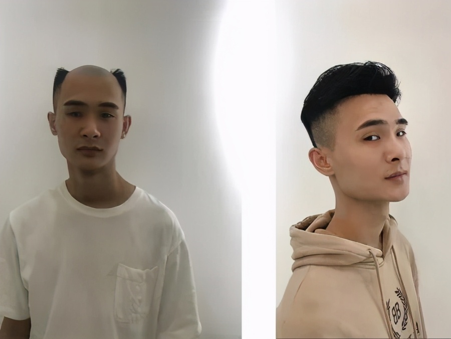 男生发际线太高可以烫发吗,发型设计男生发际线高