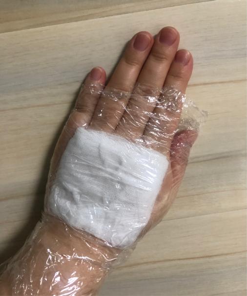 输液鼓包了疼怎么办,输液时鼓包了可以揉吗