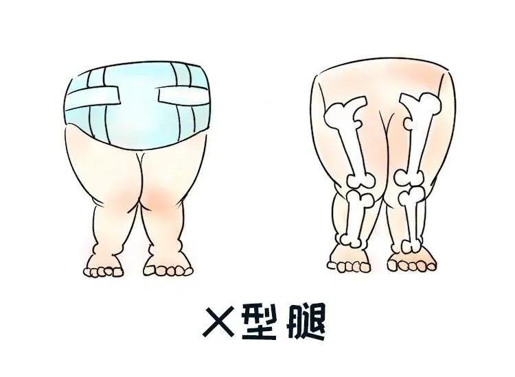 宝宝x型腿怎么走路有助矫正,2岁宝宝x型腿矫正正确方法