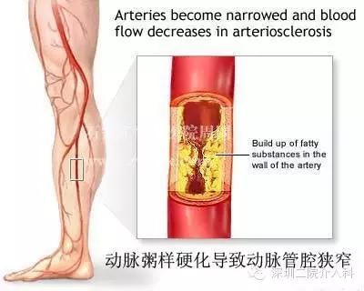 糖尿病下肢血管病变介入治疗,糖尿病足血管介入
