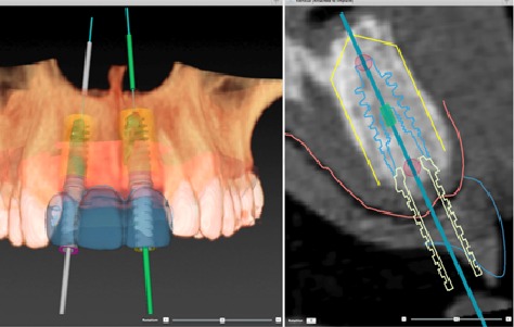 西安诺贝尔种植牙价目表,诺贝尔口腔种植牙怎么样