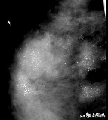 乳腺钙化怎么区分良性和恶性,乳腺钙化的诊断与分级