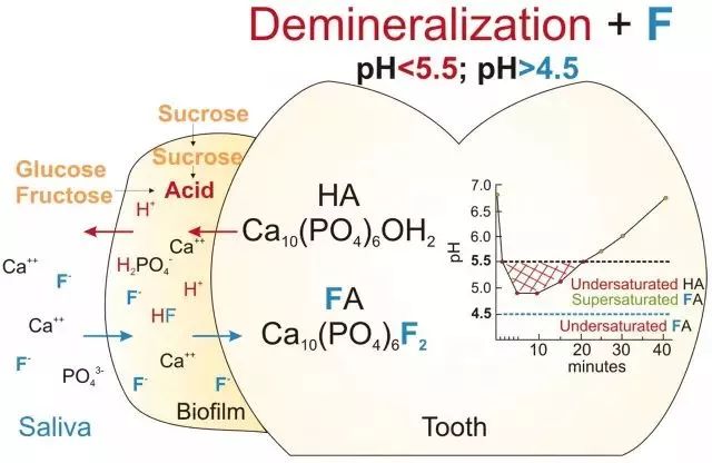 牙齿脱矿白斑怎么修复,牙医修复牙齿漏洞蛀牙全过程