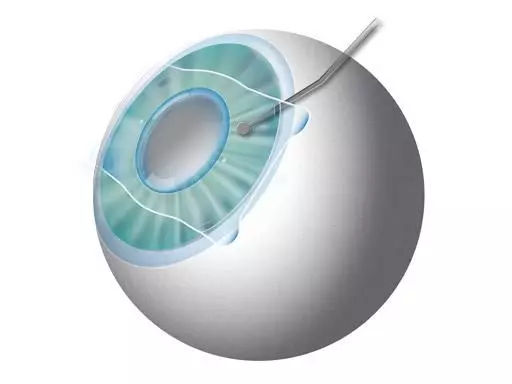 近视眼手术晶体移植和激光的区别,近视眼做了激光有什么利弊