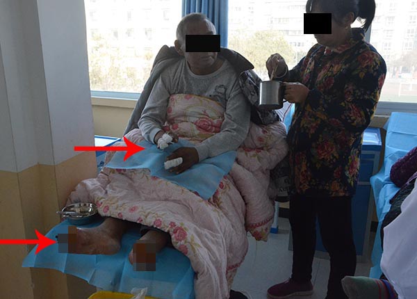 糖尿病血糖控制住糖尿病足会好吗,是不是糖尿病患者都有糖尿病足