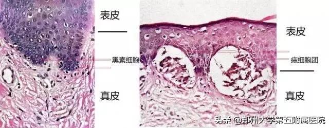点痣到哪点比较好,原来点痣那么简单