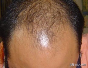 脱发真的没法治了吗,脱发真的是无药可治吗