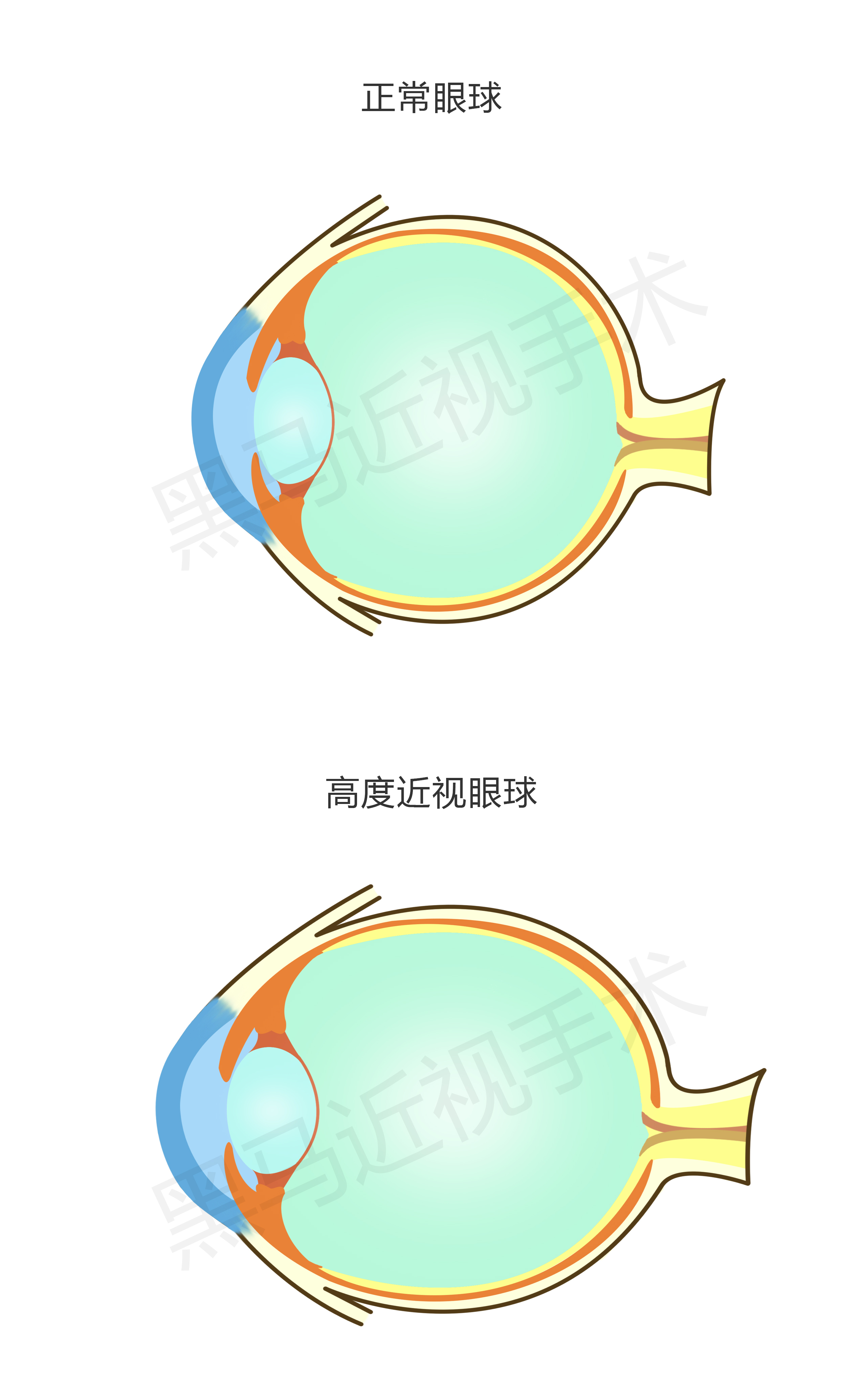 激光近视矫正手术有什么后遗症,激光治疗近视安全啊有没有后遗症