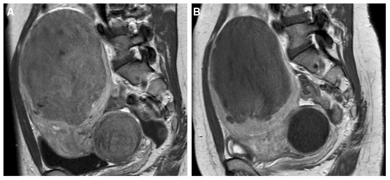 子宫肌瘤的位置、大小对介入栓塞疗效有何影响？