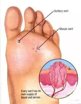 紧急！全澳多地出现“吃人菌”，感染后如同丧尸！24小时可吃一人