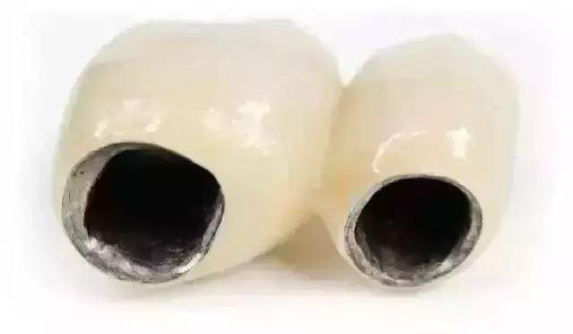 为什么烤瓷牙表面有裂纹,为什么烤瓷牙的牙龈那么黑