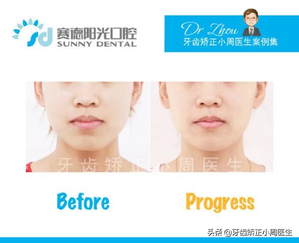 正畸牙齿打骨钉的危害,正畸打骨钉是什么感觉