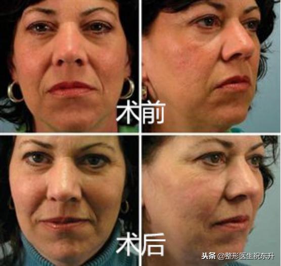 面部悬吊提升术的后遗症有哪些,面部悬吊提升术对比图