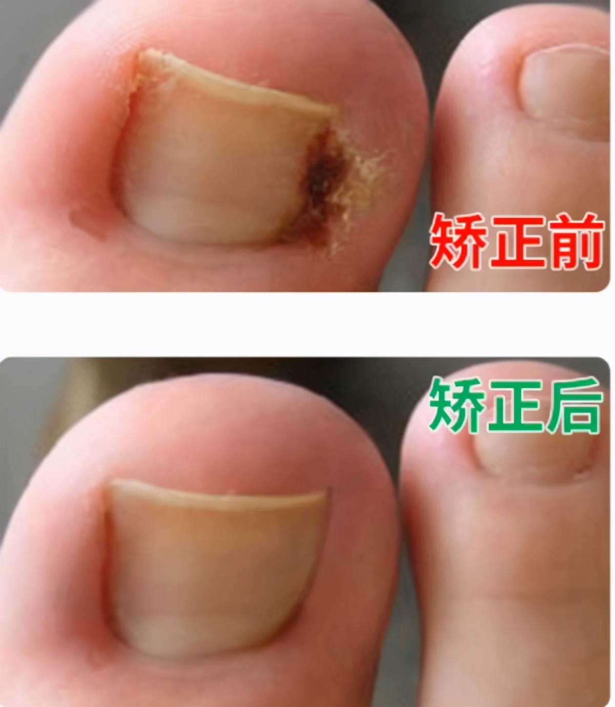 拔甲可以彻底治好嵌甲性甲沟炎吗,嵌甲甲沟炎拔了指甲还是红肿有脓