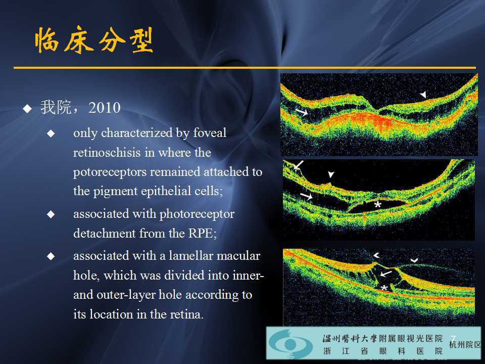 高度近视黄斑劈裂哪家医院好,高度近视黄斑劈裂中医治疗