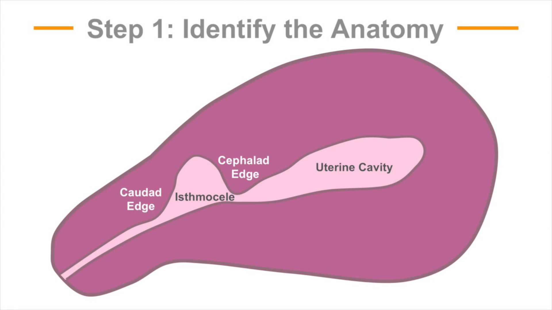 剖宫产瘢痕憩室英文,剖宫产术后瘢痕憩室诊治专家共识