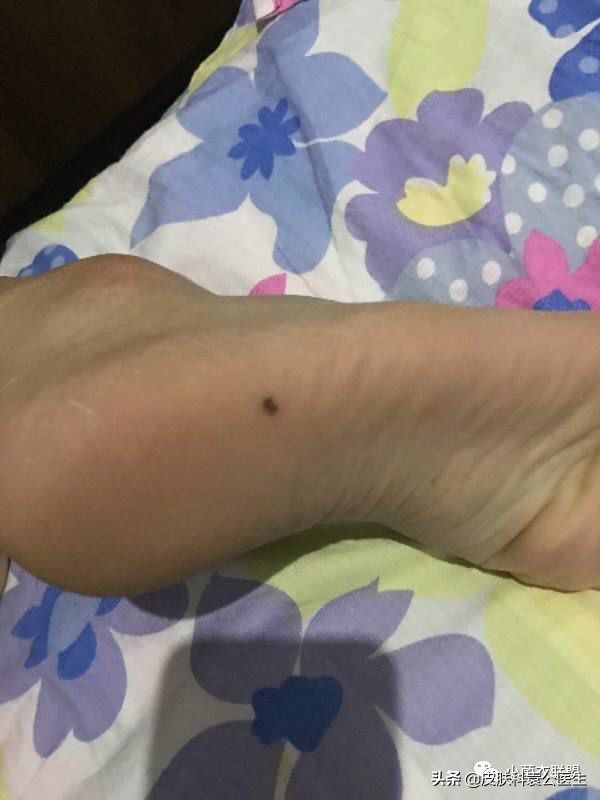 痣边缘模糊图片,痣长多大会变成黑色素瘤