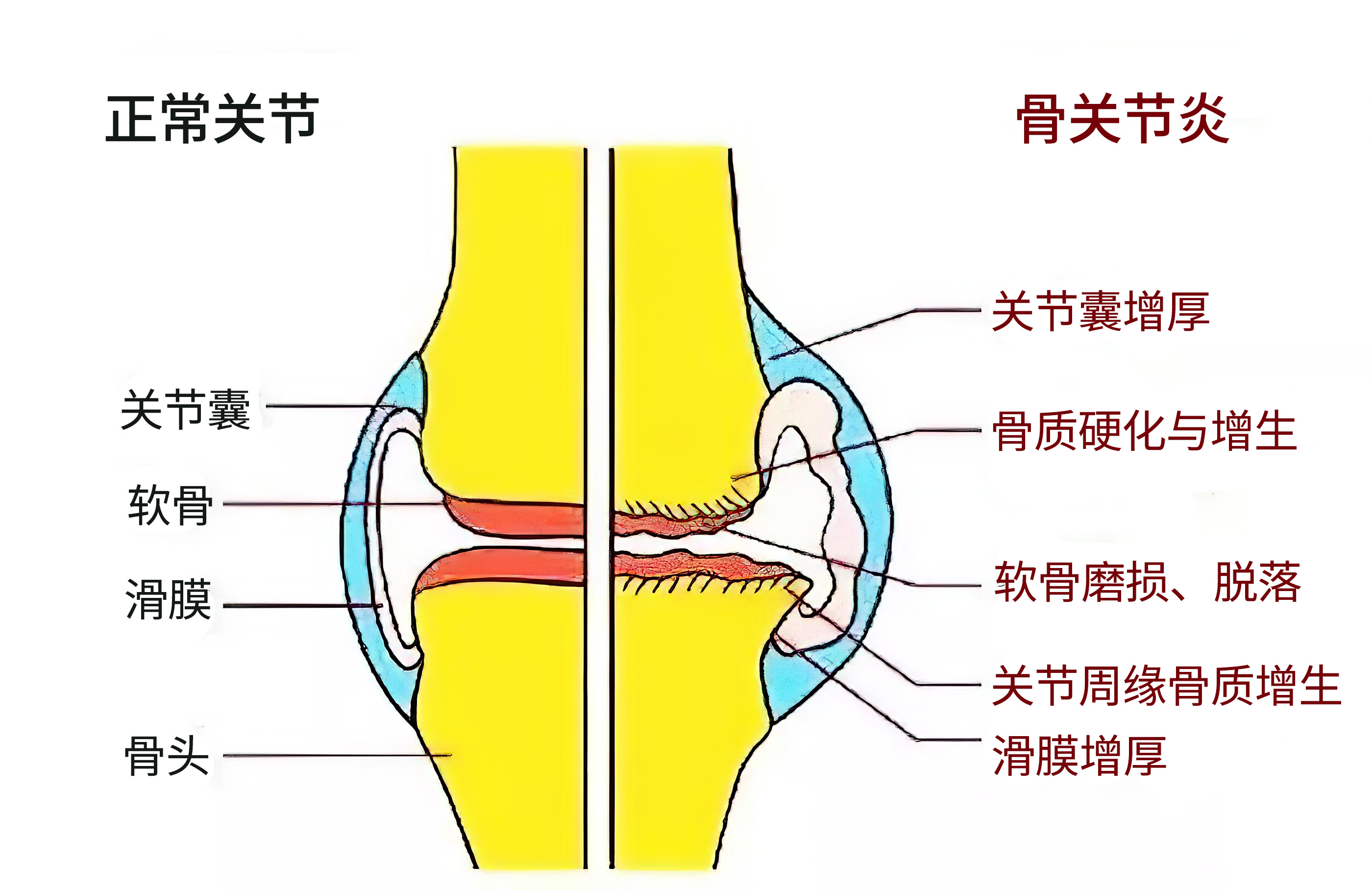 打封闭针可治骨关节炎吗,骨刺关节炎怎么治疗效果最好