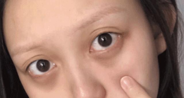 黑眼圈越来越重怎么搞定黑眼圈,简单有效缓解黑眼圈的两个小方法