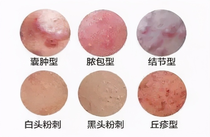 抗痘攻略,超全战痘指南