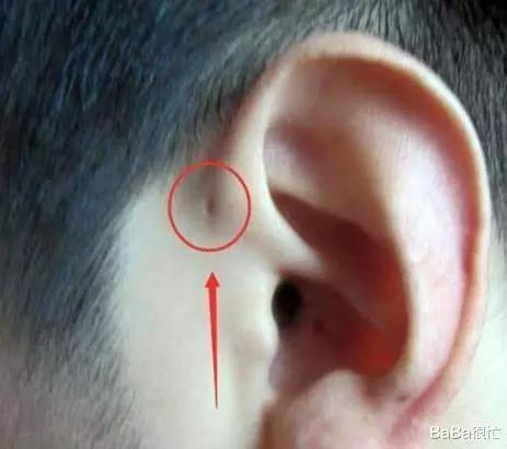为什么有些新生儿耳朵大有些小,为什么新生儿耳朵旁边有小肉疙瘩