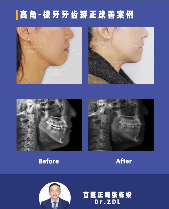 戴牙套矫正牙齿脸型会变好看吗,隐形牙套矫正后脸型变化