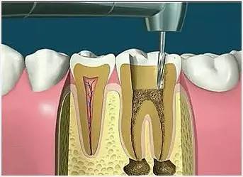 根管治疗后戴牙冠价格,牙髓炎根管治疗价格