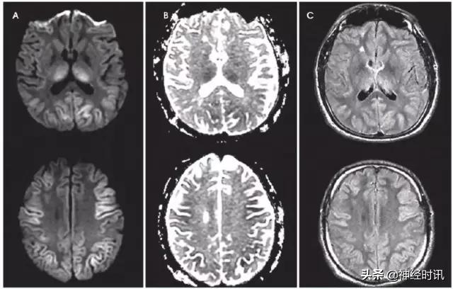 脑卒中的快速识别ppt,脑卒中神经影像学实例解析