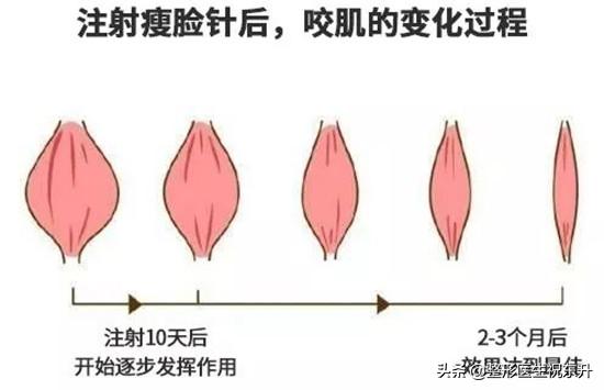 打瘦脸针和打玻尿酸哪个更安全,打了瘦脸针跟玻尿酸要注意啥