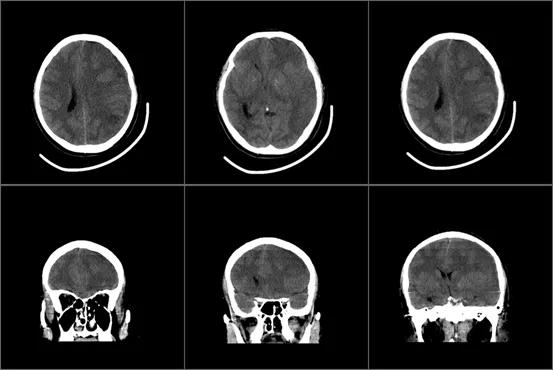 一颗智齿惹的祸,一颗智齿引发的事件