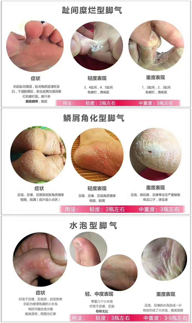 脚气特别的痒怎样缓解一下,脚气瘙痒难忍请试试这个方法