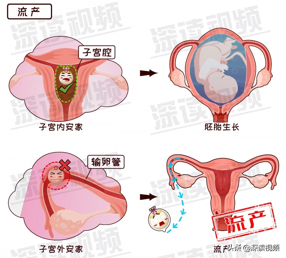 安以轩开刀保命实因宫外孕?受精卵去哪了?竟让孕妈流产大出血?
