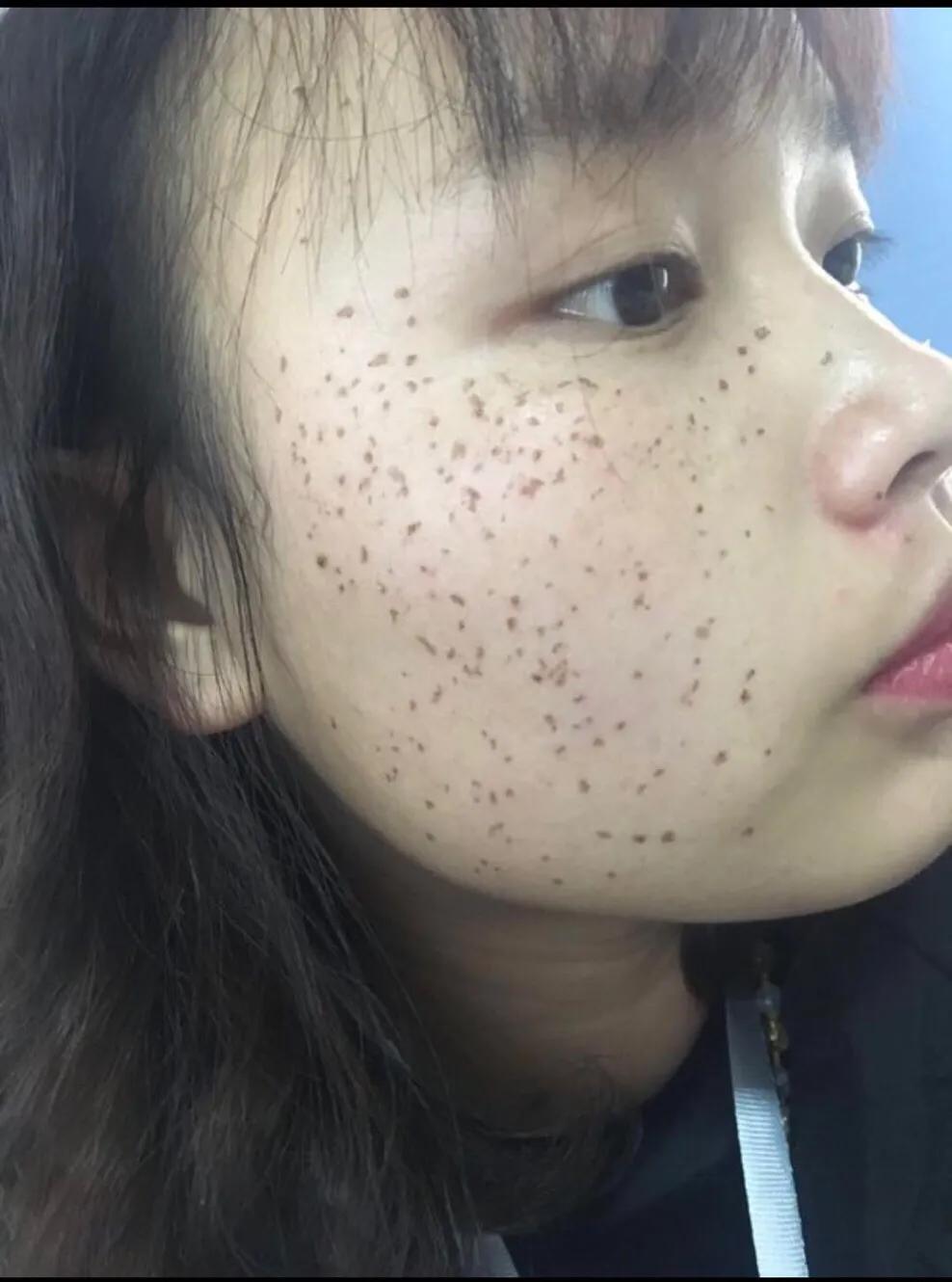 遗传性雀斑食疗方法,遗传性雀斑祛斑霜