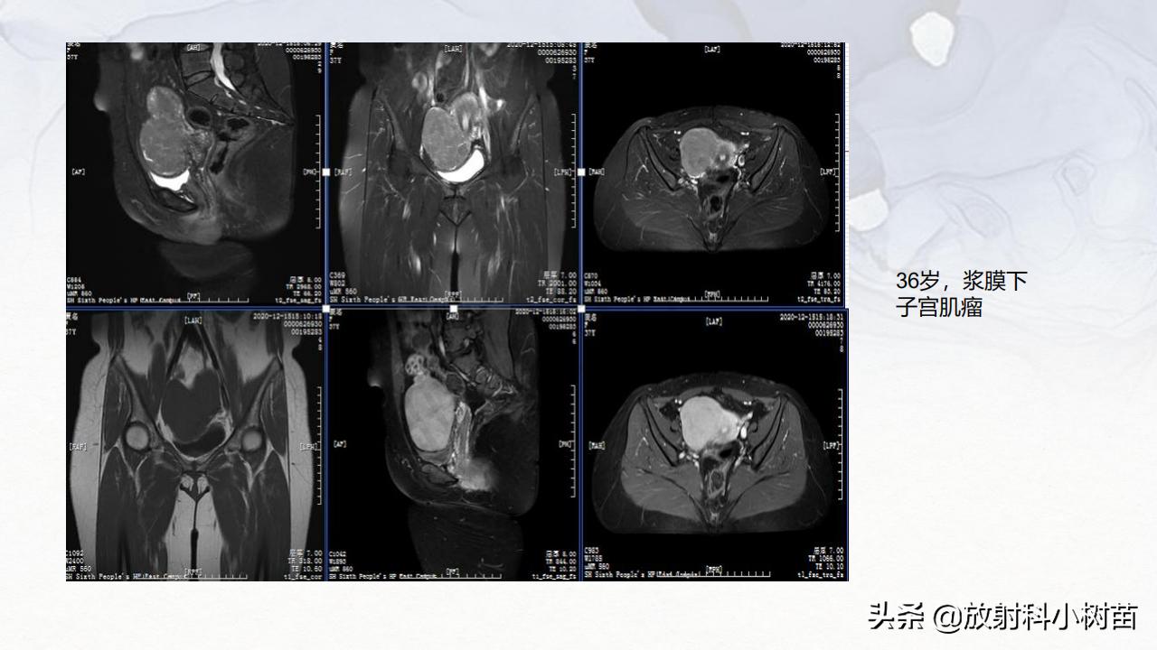 女性盆腔mri解剖图谱,泌尿生殖系统x线解剖