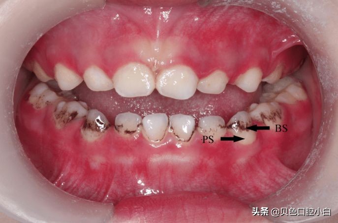 宝宝牙齿黄黄的刷不干净怎么办,宝宝不爱刷牙牙齿黑了怎么办