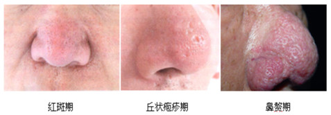 如何应对酒糟鼻,得了酒糟鼻怎么处理好得快