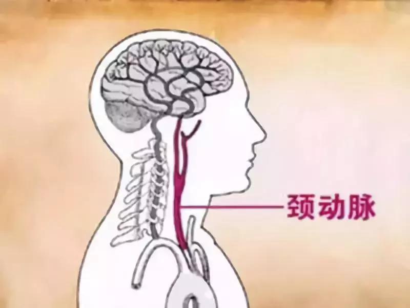 颈动脉有斑块怎么预防中风,双侧颈动脉斑块引发的脑梗中风