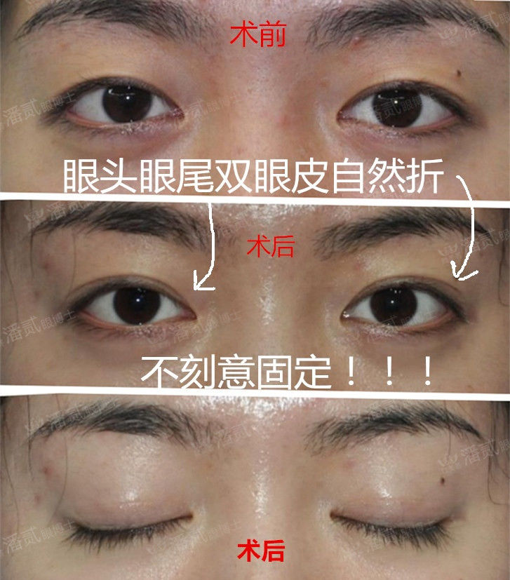 自己的双眼皮太深显老怎么修复,做的双眼皮一笑有皱纹怎么修复